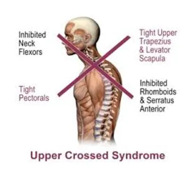 upper crossed syndrome diagram